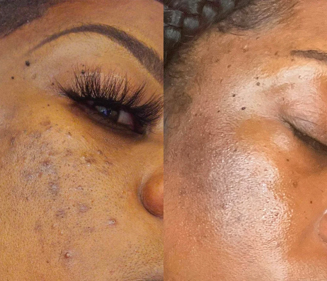 Dark spot correcting glow serum before and after